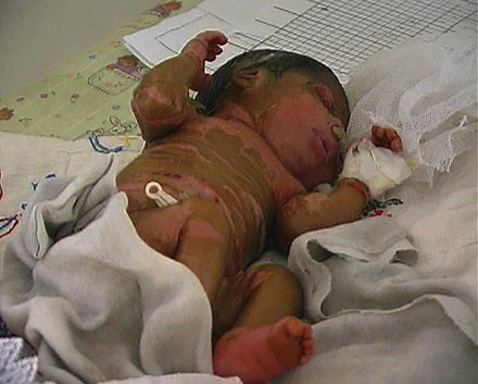 Missgebildetes Kind im Kinderkrankenhaus in Bagdad - starb nach zwei Tagen.
